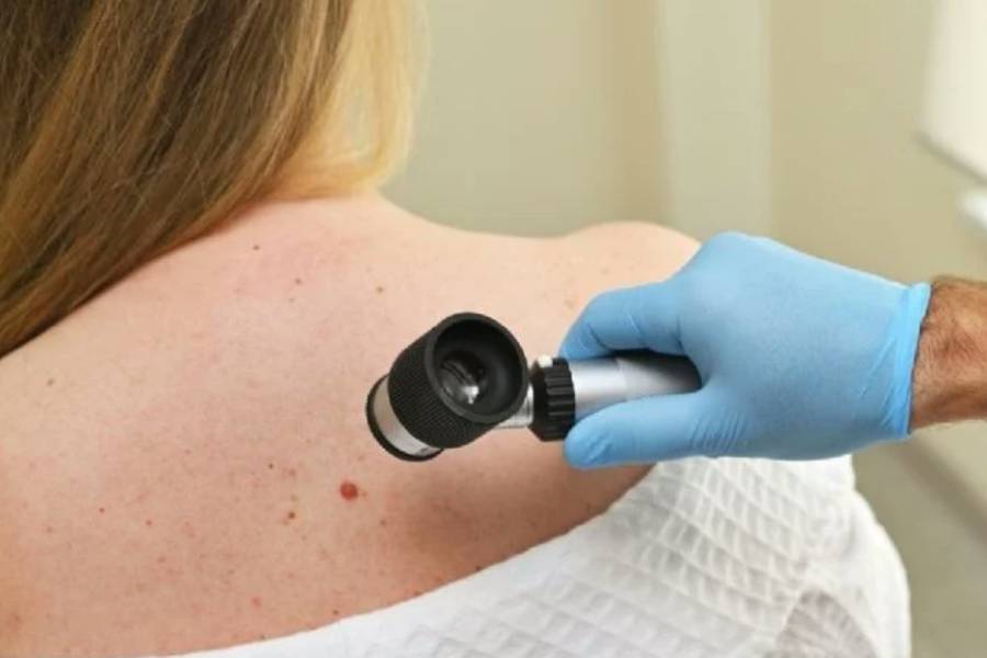 Advierten que los casos de melanoma podrían aumentar más del 50% para 2040