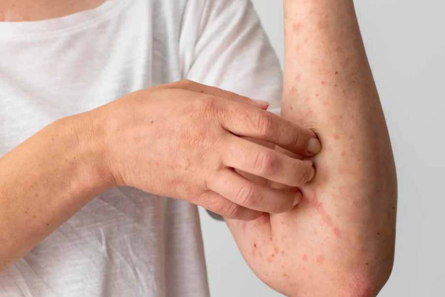 Alerta por un nuevo caso importado de sarampión en el país