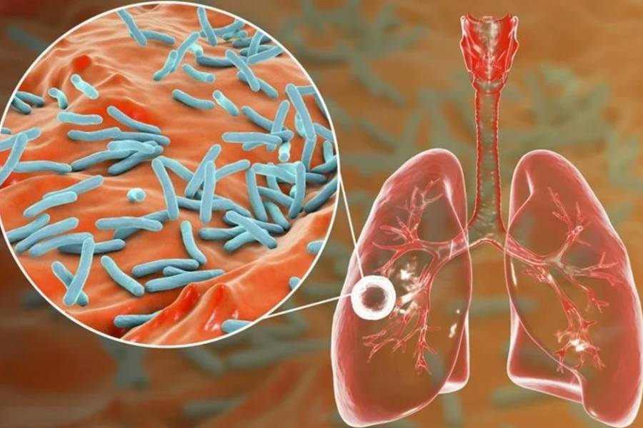Tuberculosis: actualizaciones sobre una de las principales causas de muerte por agentes infecciosos