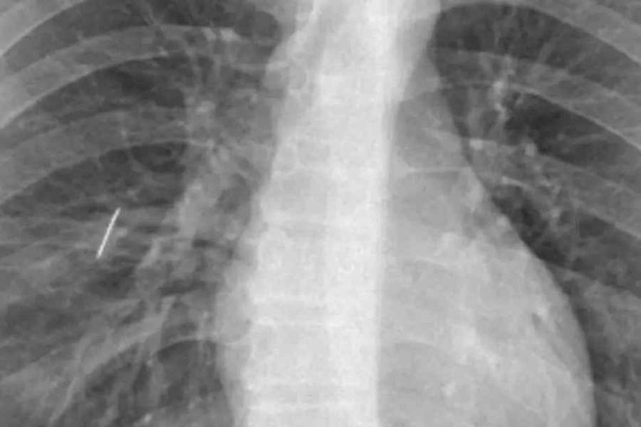 Le extraen una aguja de un pulmón a un niño en Catamarca